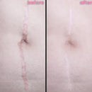 DermaSil | Fita Cicatrizante